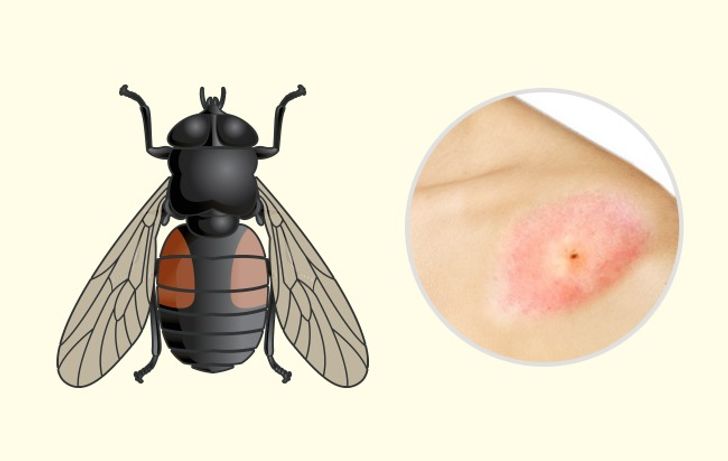 10 Bug Bites Anyone Should Be Able to Identify 10 Usa People 10 Bug Bites Anyone Should Be Able to Identify